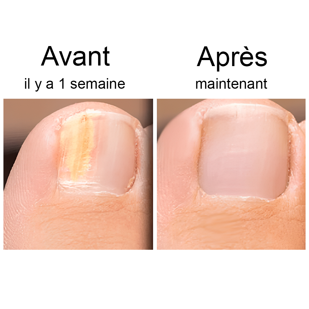 STOP AUX MYCOSES ONGULAIRES